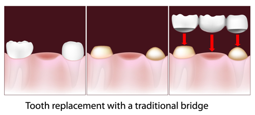 Tooth replacement with a conventional bridge